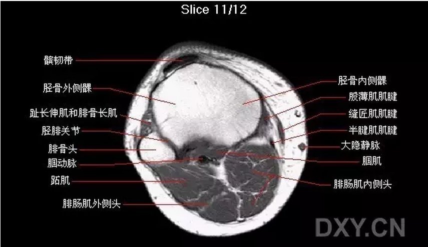 關節影像膝關節的磁共振mri解剖表現