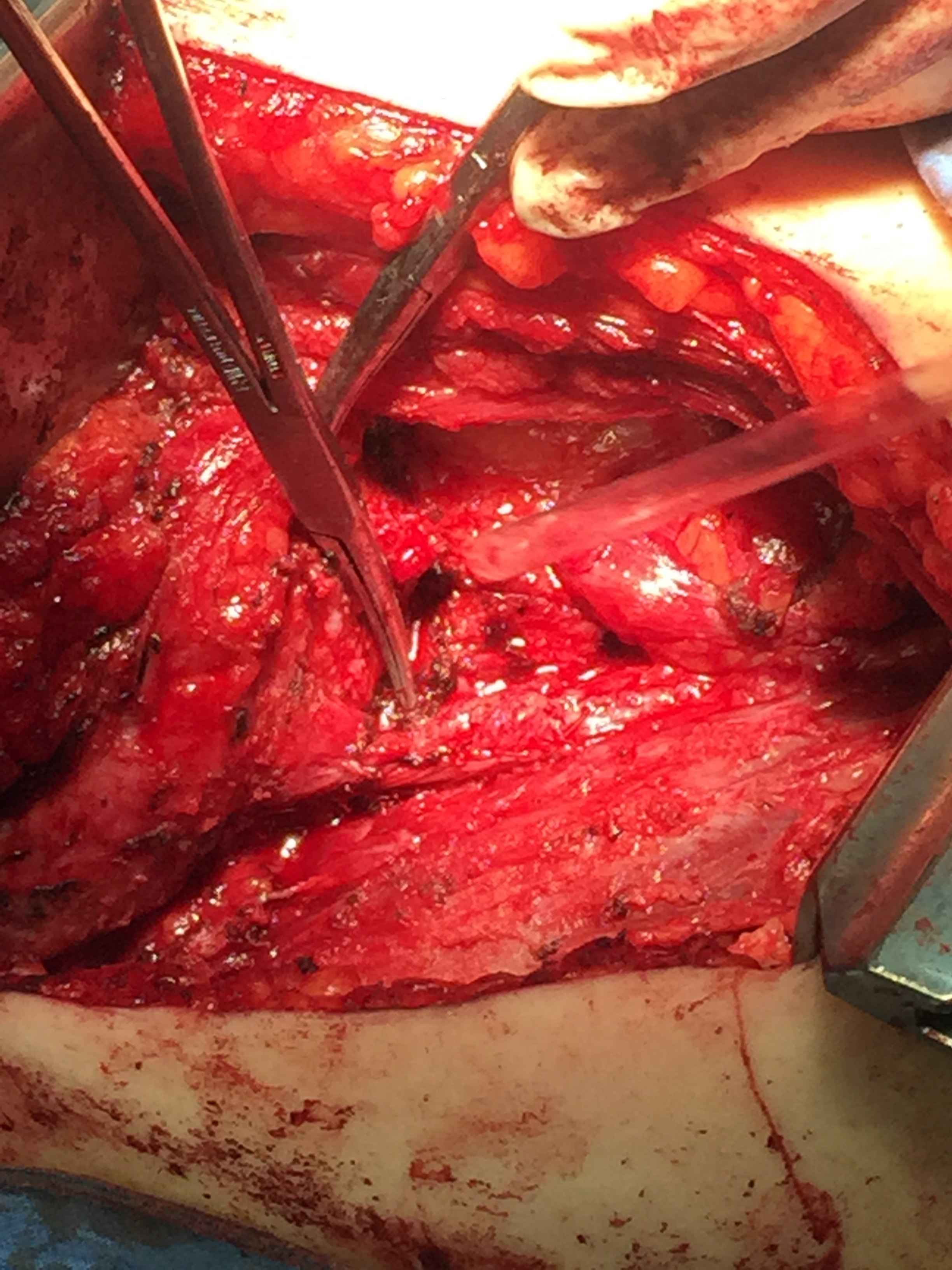 输尿管上段损伤修复3-----开放肾盂瓣成形术 - 好大夫在线