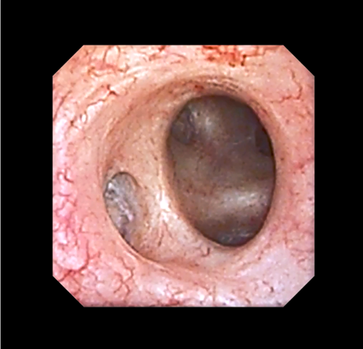 血尿十年,且有时出血量较大,并出现血块,nmp22阳性,fish阴性,遂行输尿