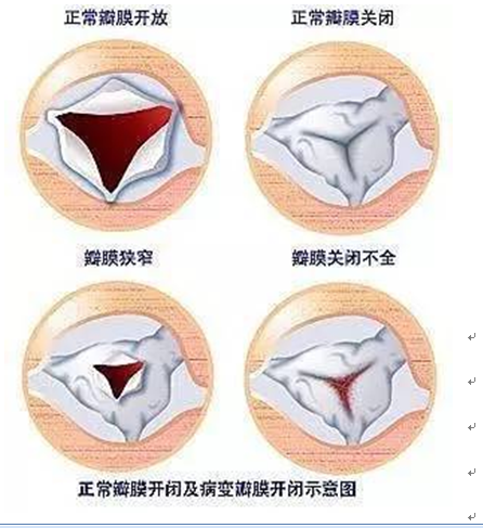 什么是主动脉瓣疾病? - 好大夫在线
