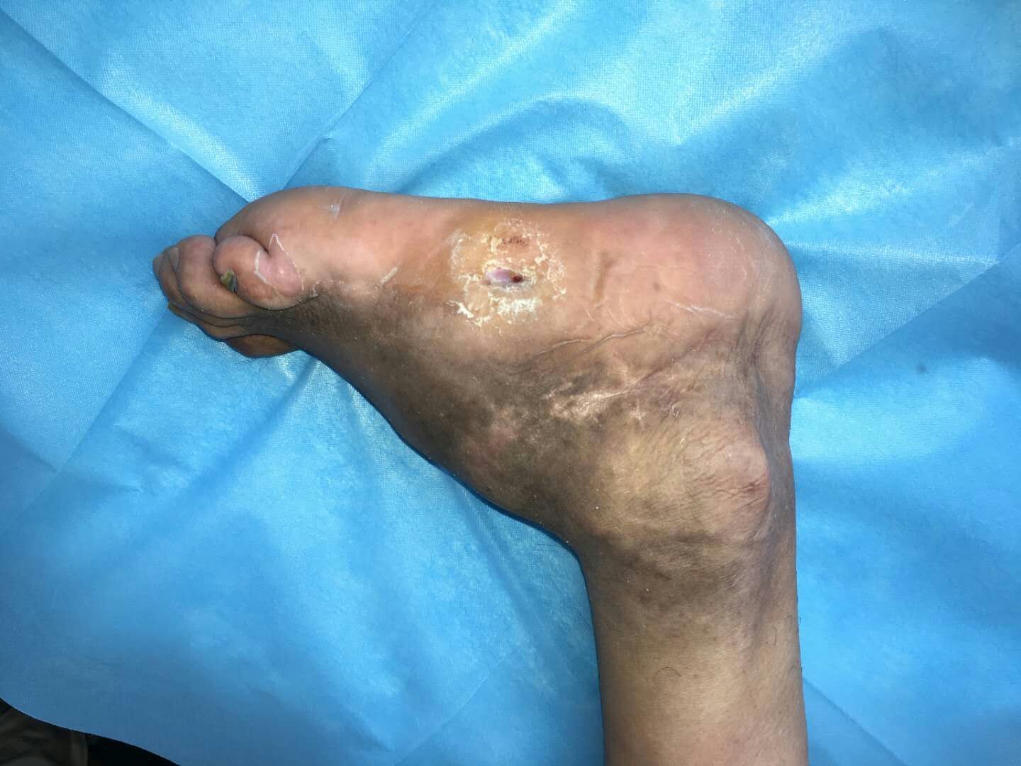 糖尿病足的综合治疗 - 好大夫在线