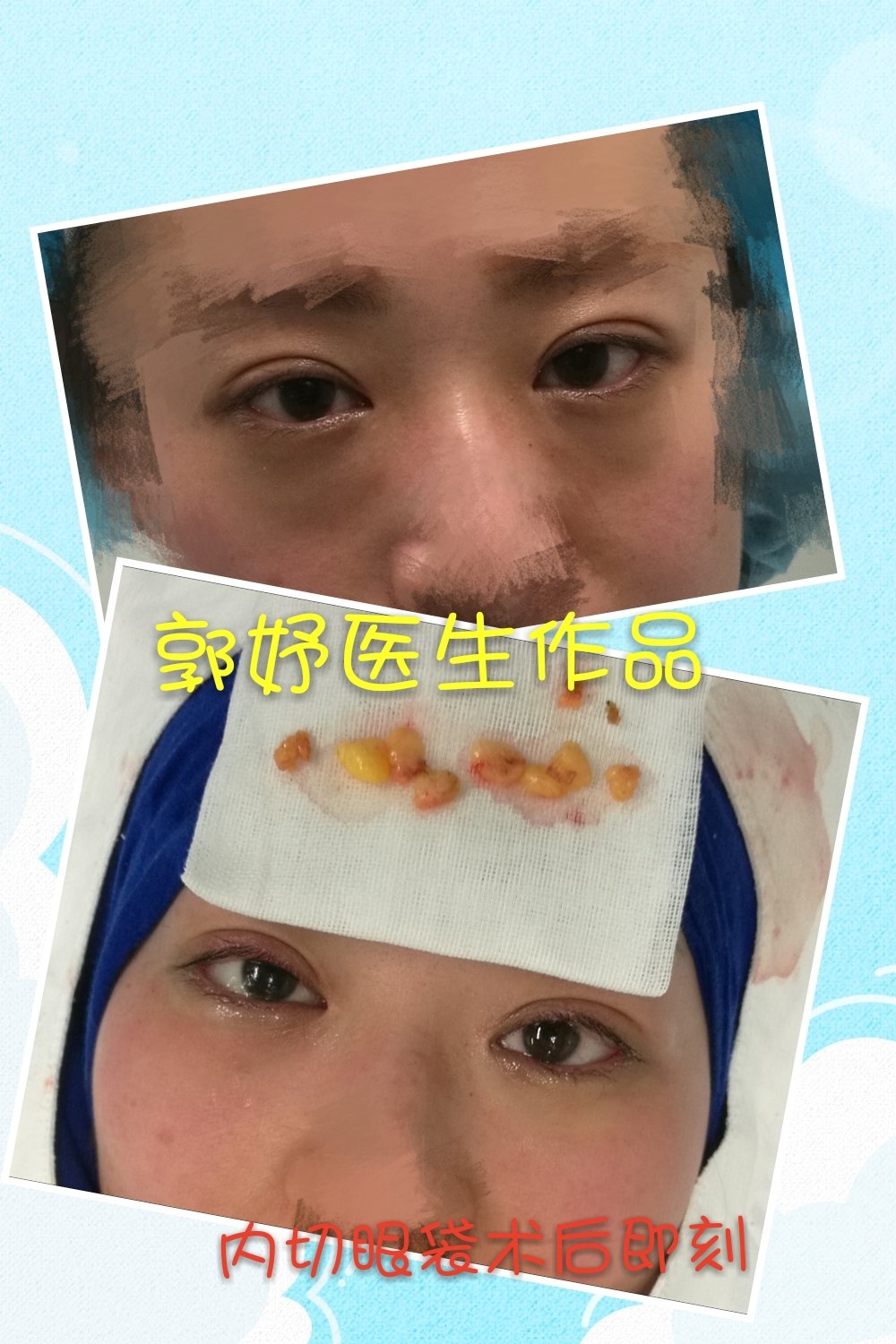 全切双眼皮内眼角术后四个月 内切眼袋术后即刻案例 - 好大夫在线