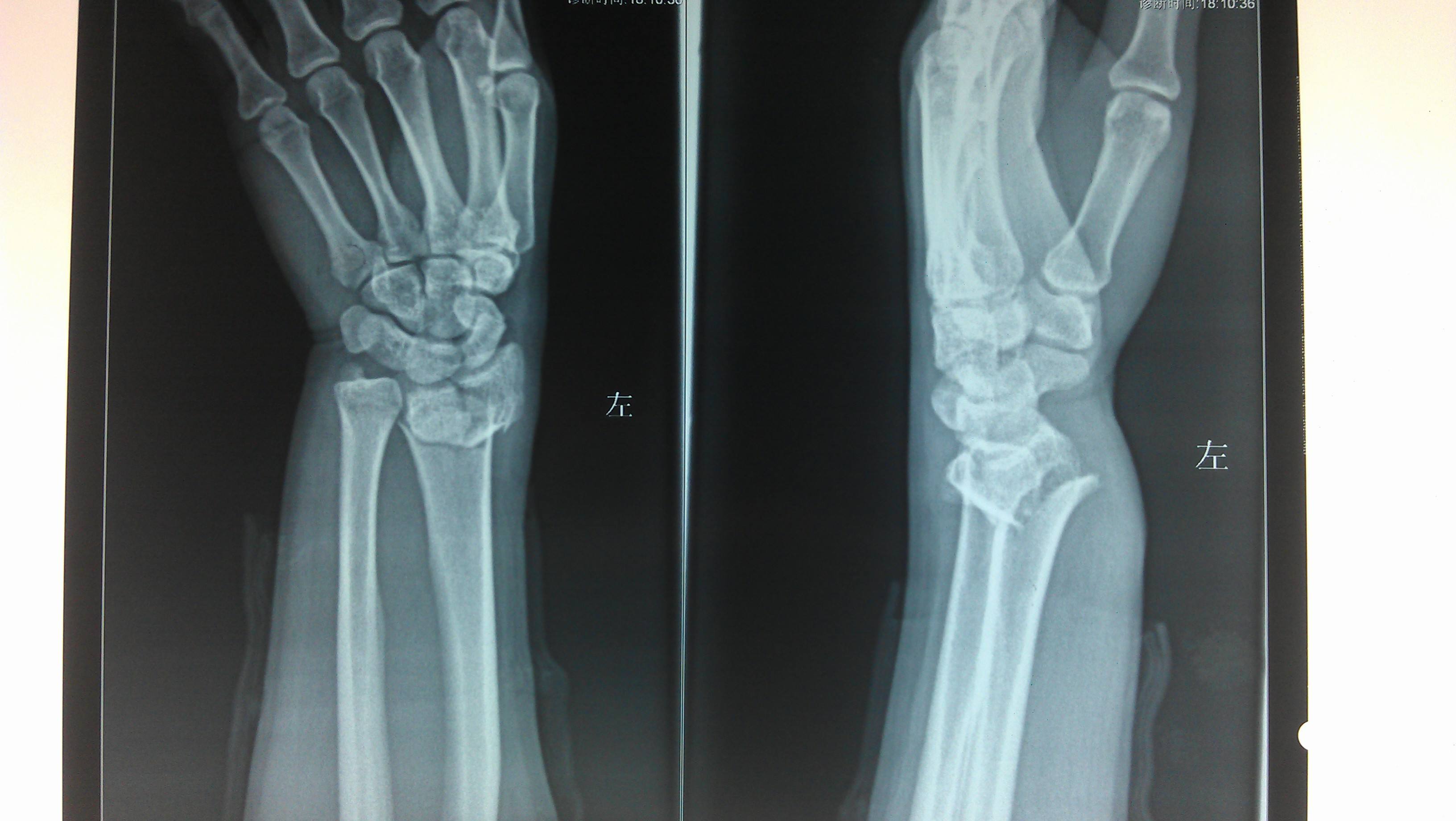 正常左手桡骨远端图片图片