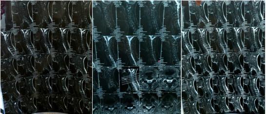 病例:颈椎反曲+脖子疼是颈椎病吗?该怎么办?