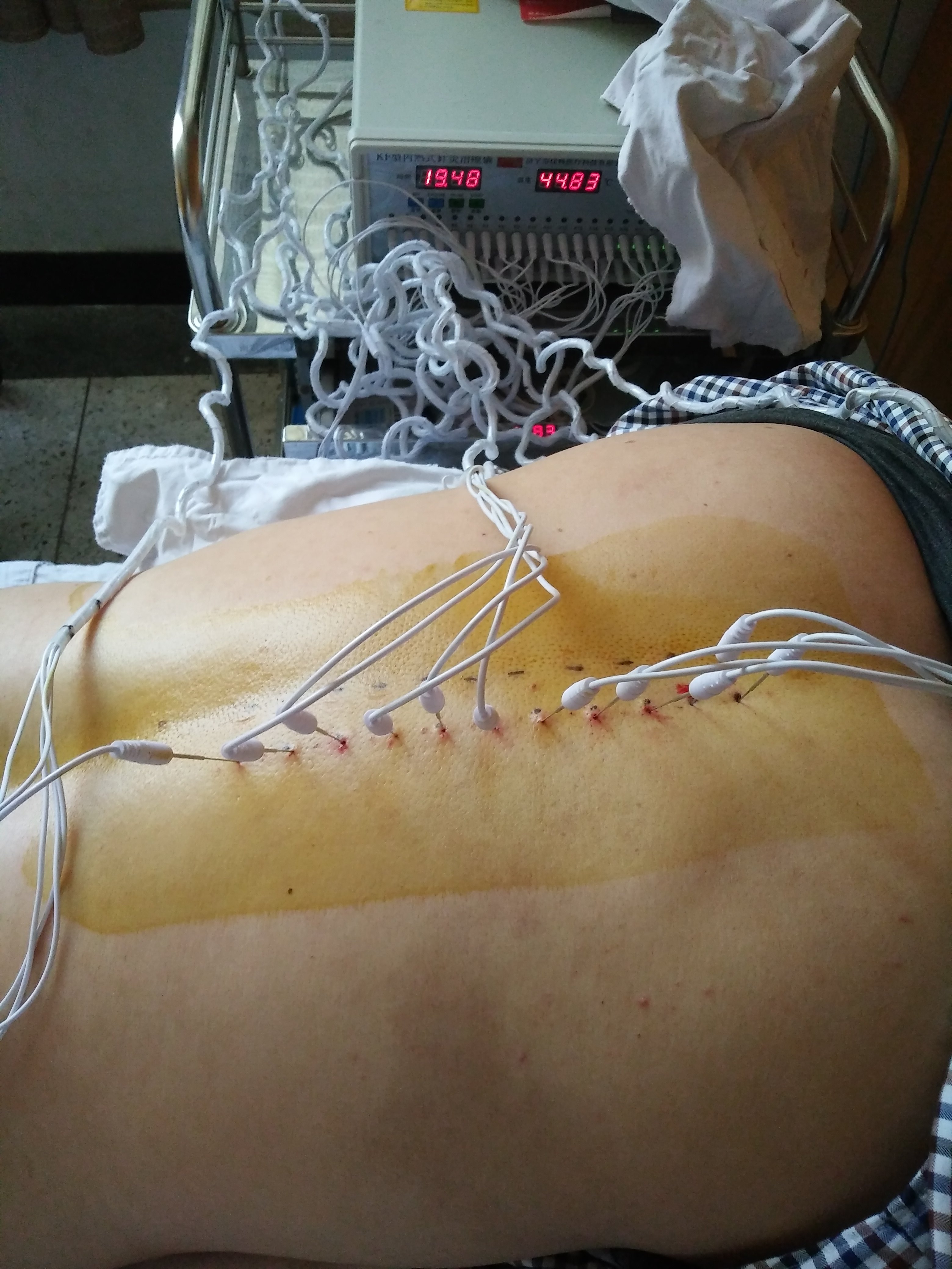 已停用,普瑞巴林1日1颗,几天后继续睡减量,隔日一次半年前胸背部疱疹