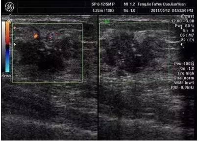 乳腺彩超全过程图片
