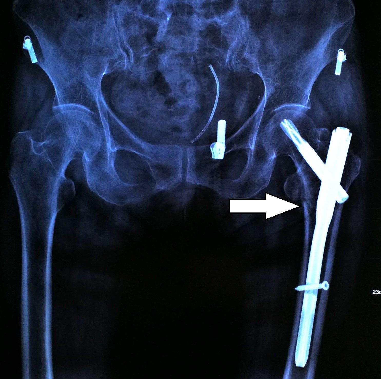 髋关节骨质疏松骨折治疗的完美演绎