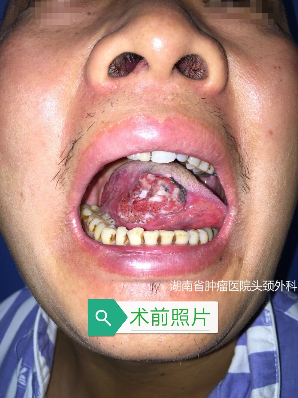 舌癌的手术治疗 附术前 术后照片 舌癌 病因 症状 检查 手术 日常护理 好大夫在线 舌癌的手术治疗 附术前 术后照片 舌癌 病因 症状 检查 手术 日常护理 好大夫在线