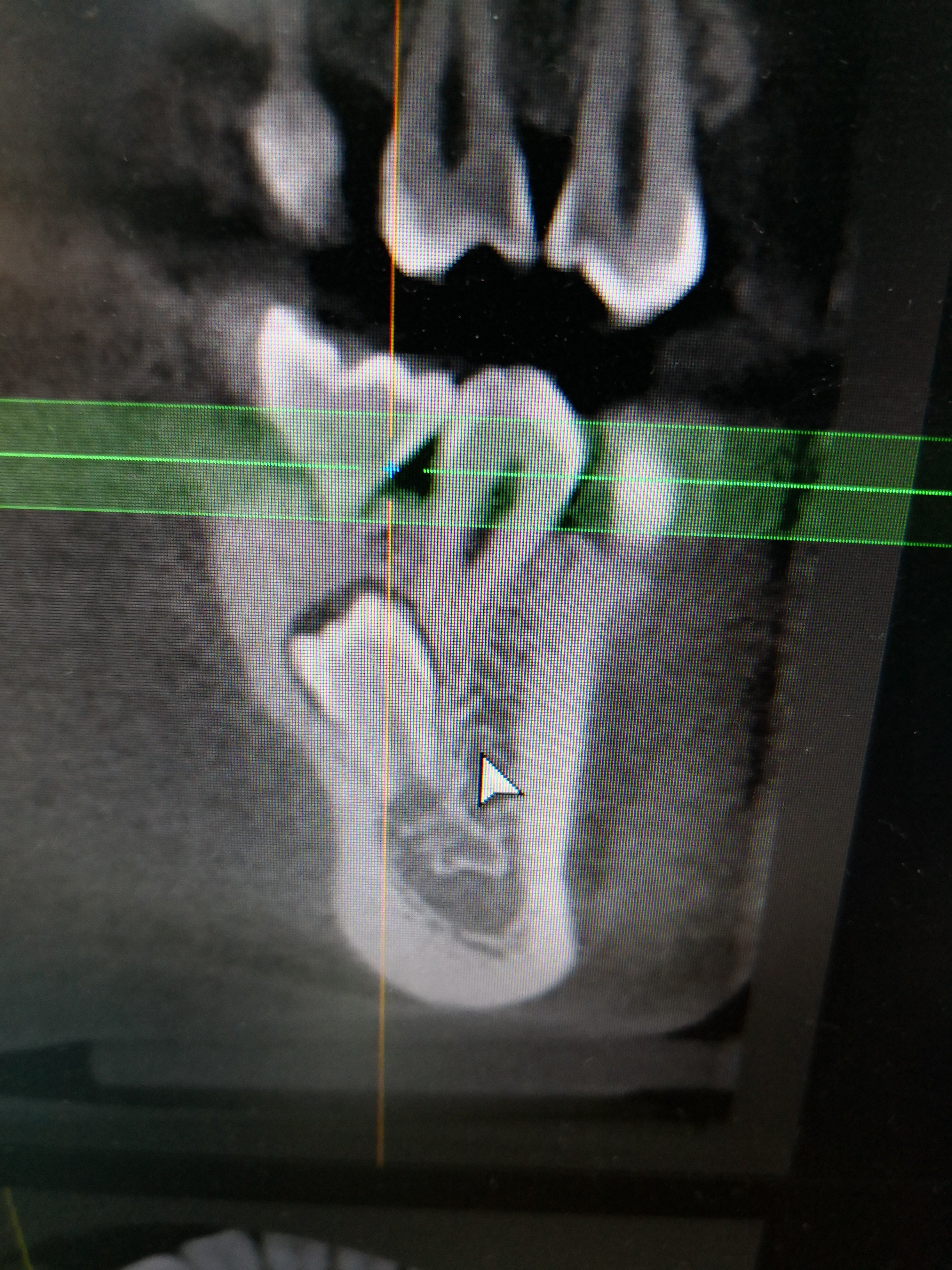 含牙囊肿图片x线图片