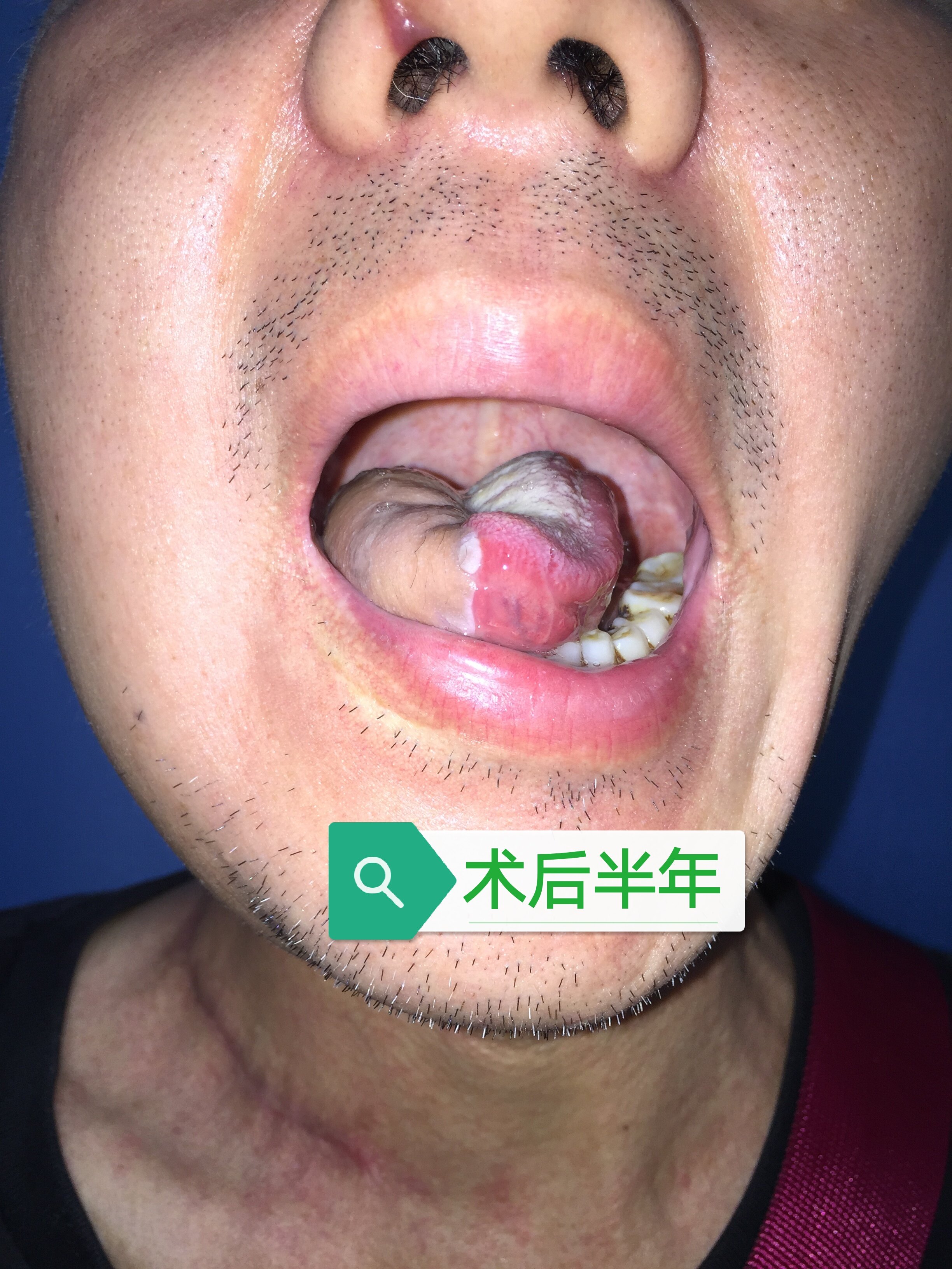 舌癌的原因图片