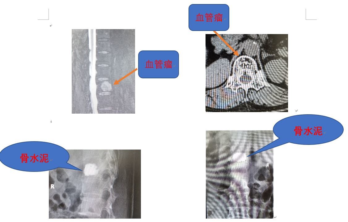 脊柱血管瘤 血管瘤 疾病介绍 脊柱血管瘤 血管瘤 疾病介绍