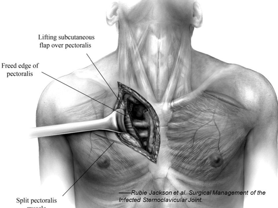 胸锁关节积气图片