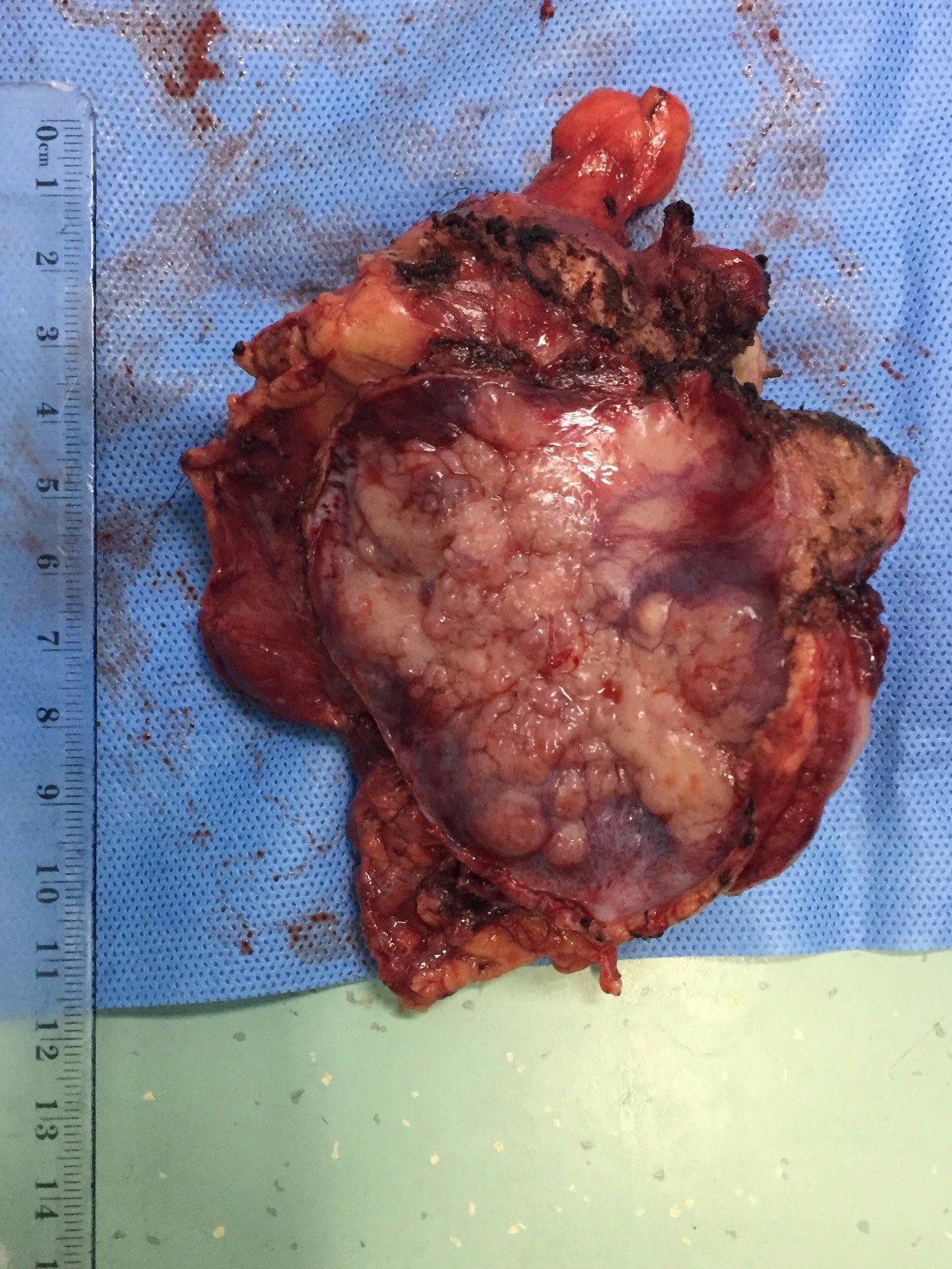 一例伴有重度皮肌炎的巨大胸腺癌在北京同仁医院得到成功救治