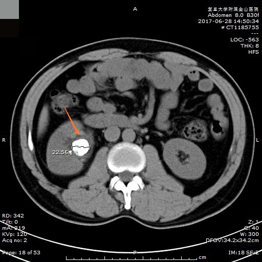 男性泌尿系统解剖图ct图片