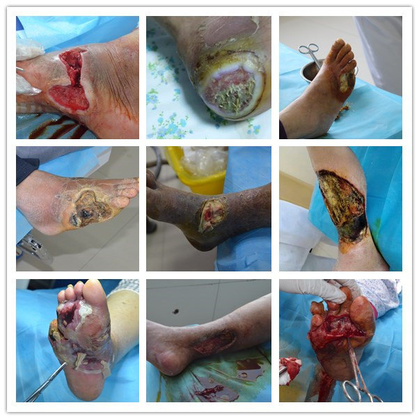 糖尿病腿酸走路无力怎么办?