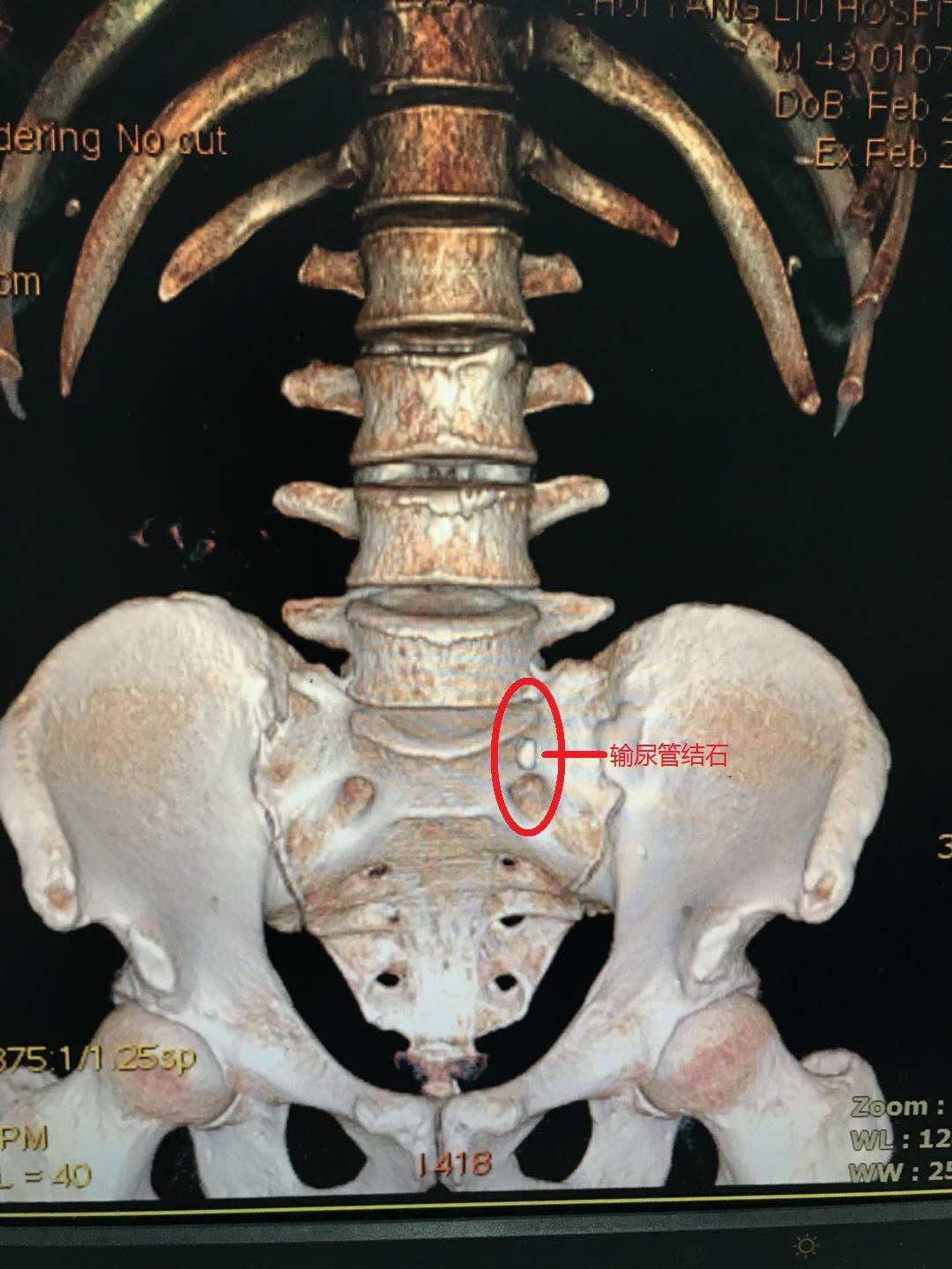 輸尿管結石ct診斷好