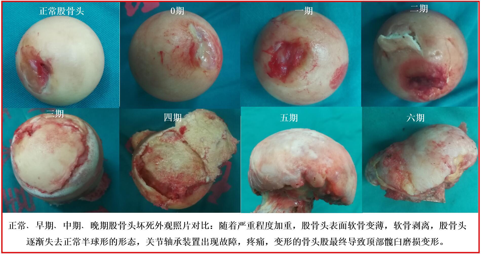 股骨头坏死的分期(steinberg 分期)