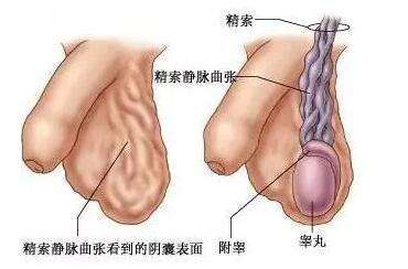 男人的小蚯蚓:精索静脉曲张和男性不育症