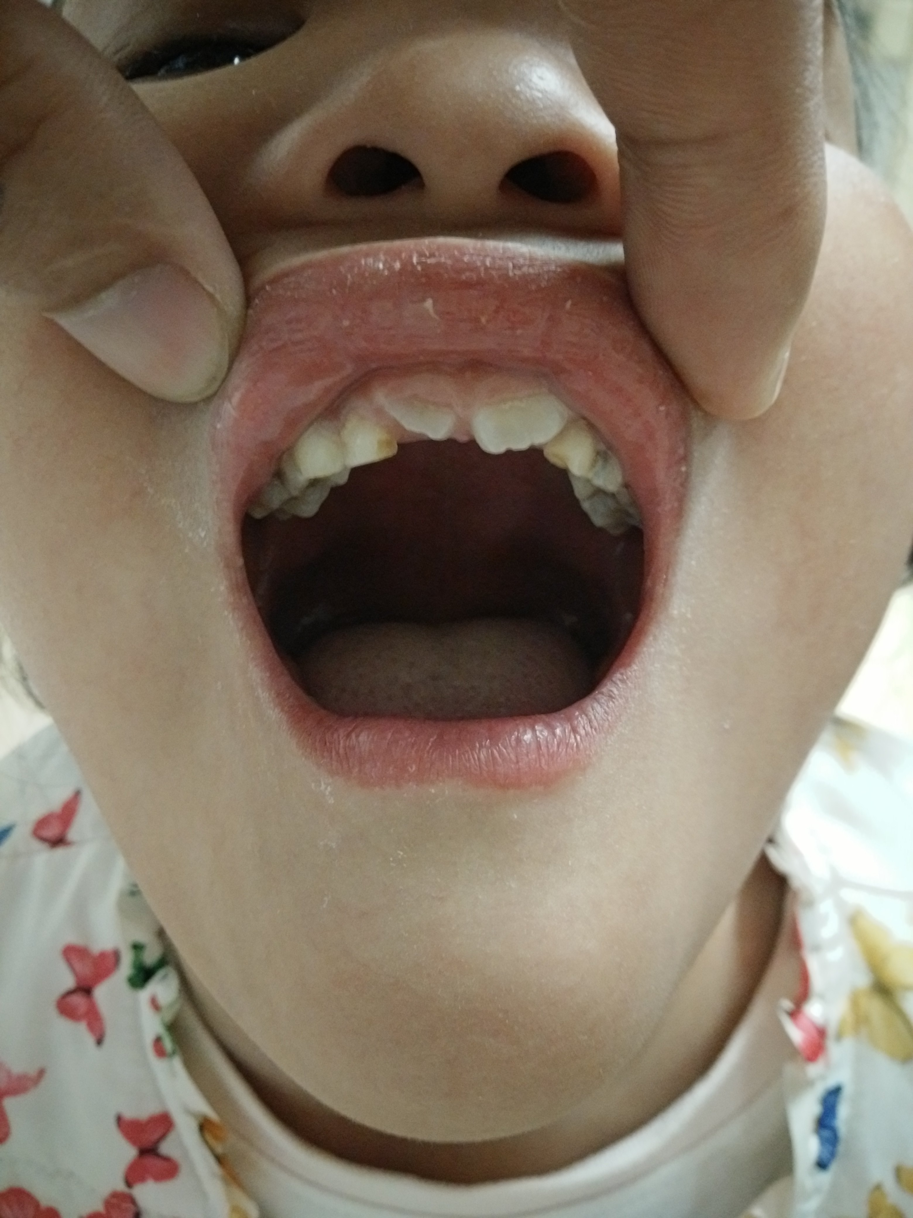 《一》定义:axenfeld-rieger综合征是指双眼发育缺陷,伴或不伴有全身