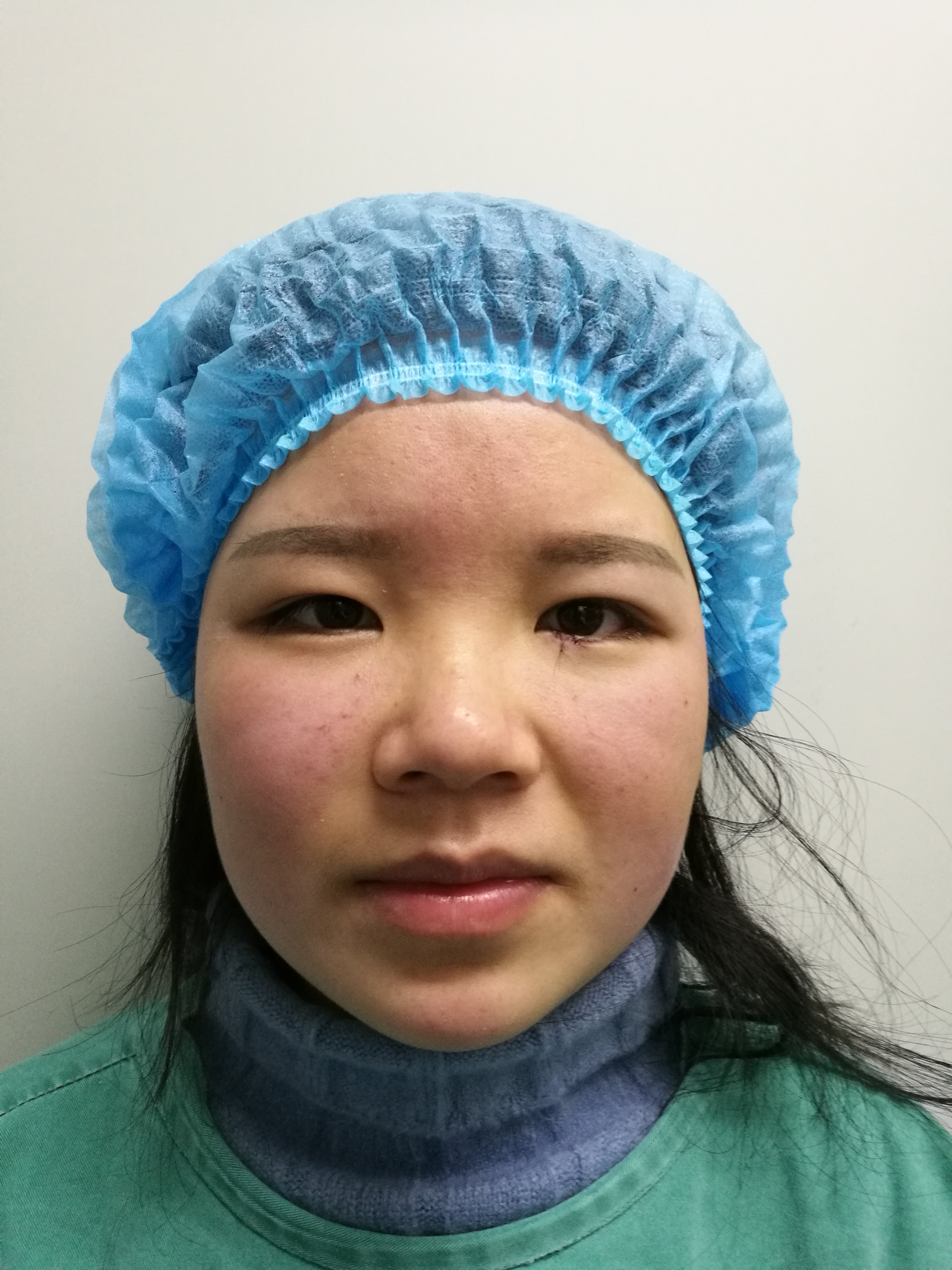 睑缘痣切除实例