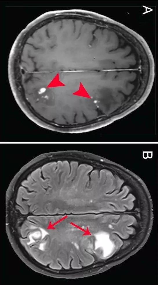 teaching neuroimages: intracranial foreign body reaction after