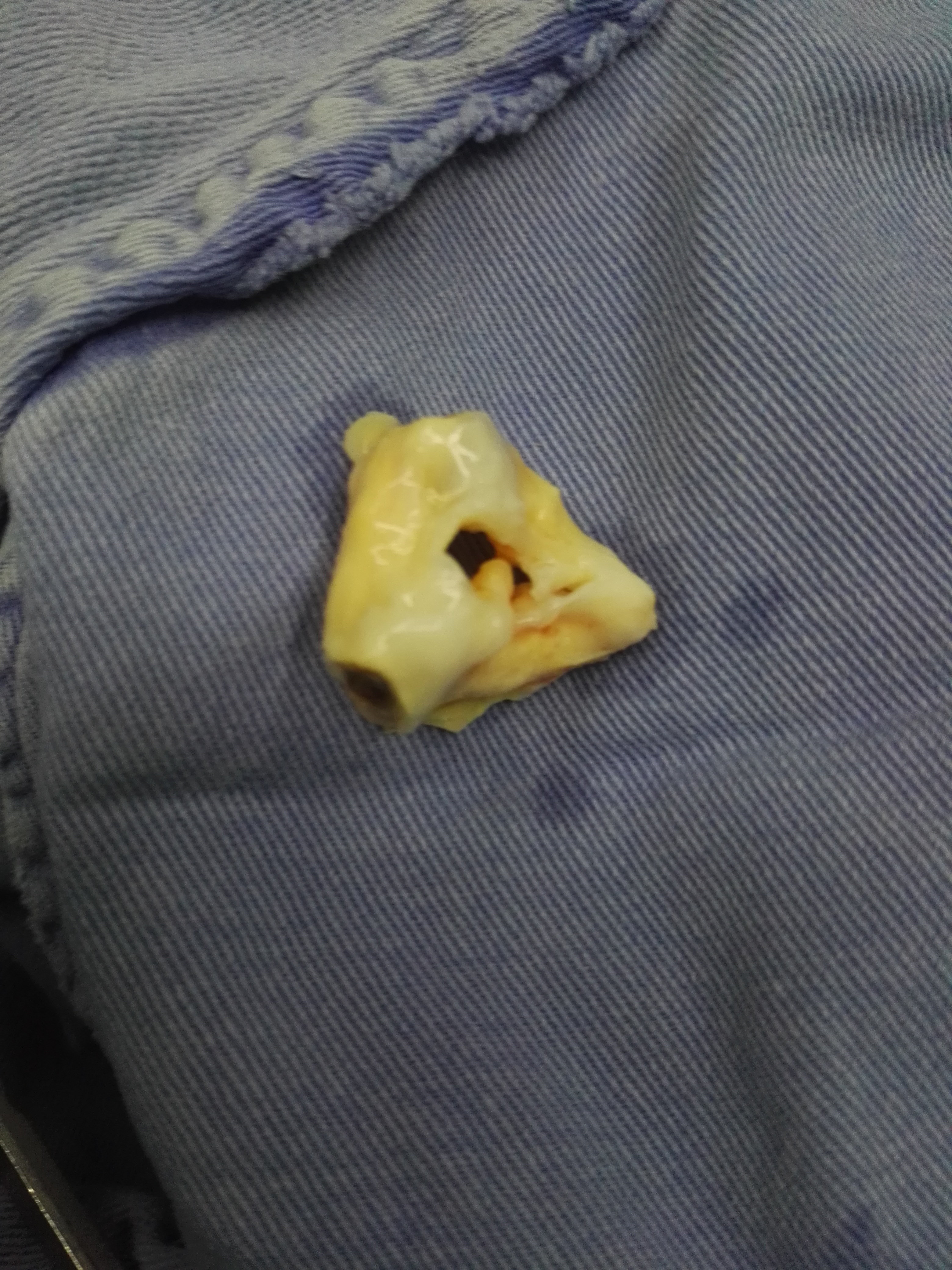 70多岁联合瓣膜病,瓣口如黄豆 - 好大夫在线