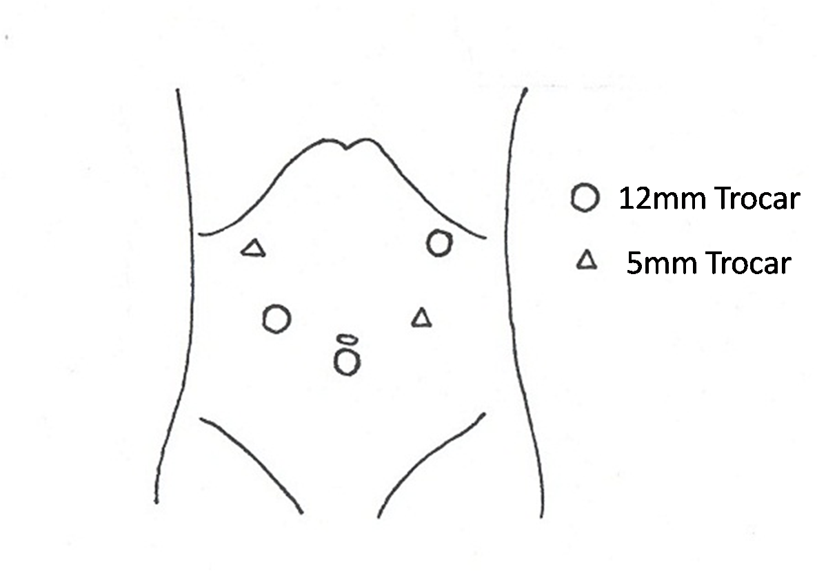 腹腔镜trocar位置图片