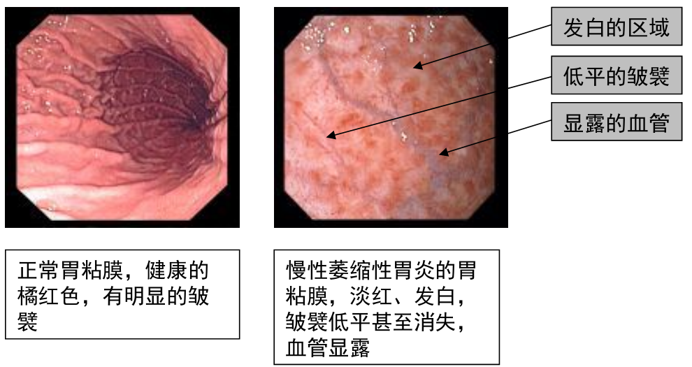 慢性萎缩性胃炎