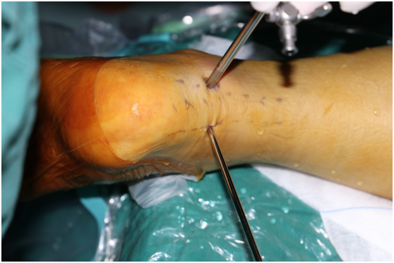 踝关节撞击综合征关节镜微创治疗