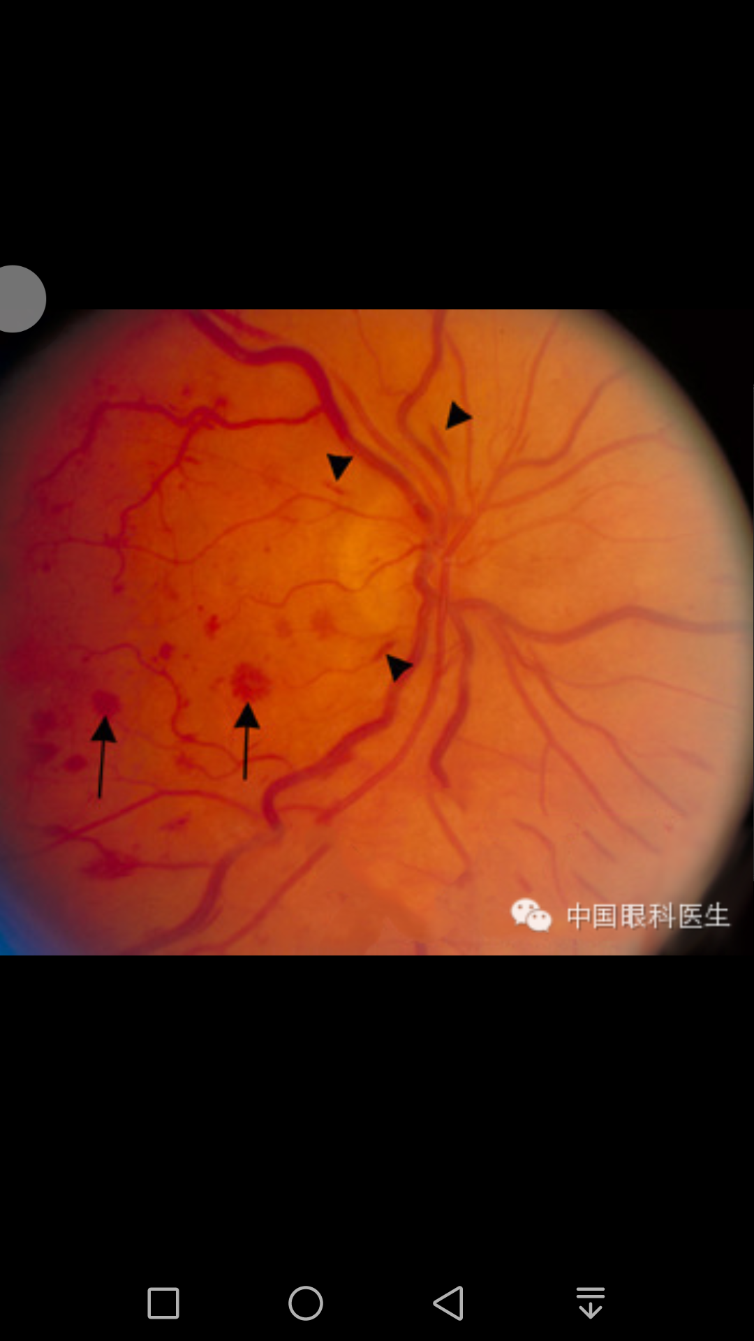 蛛网膜下腔出血症状图片