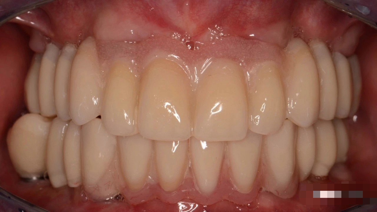 全口牙掉光了肿么办?木事,牙种植还你一口新牙齿_牙齿种植_疾病介绍_