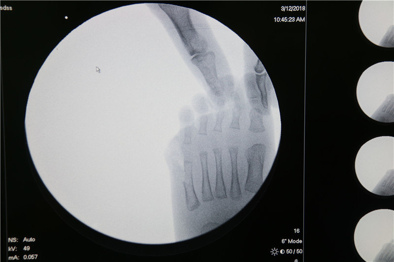六趾畸形六个脚趾头迷信说法六趾畸形是什么原