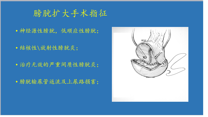 膀胱扩大手术分类及介绍 - 好大夫在线