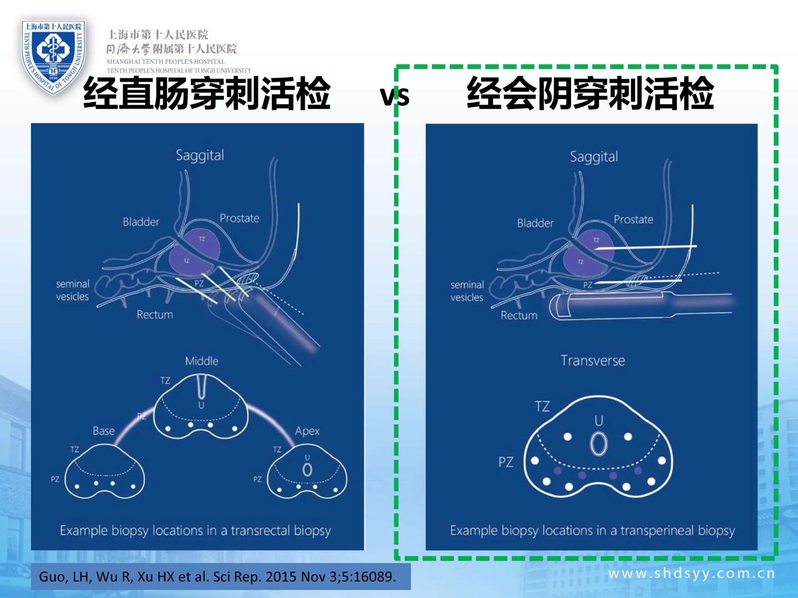 前列腺癌早期诊断的融合靶向精准穿刺活检实战病例