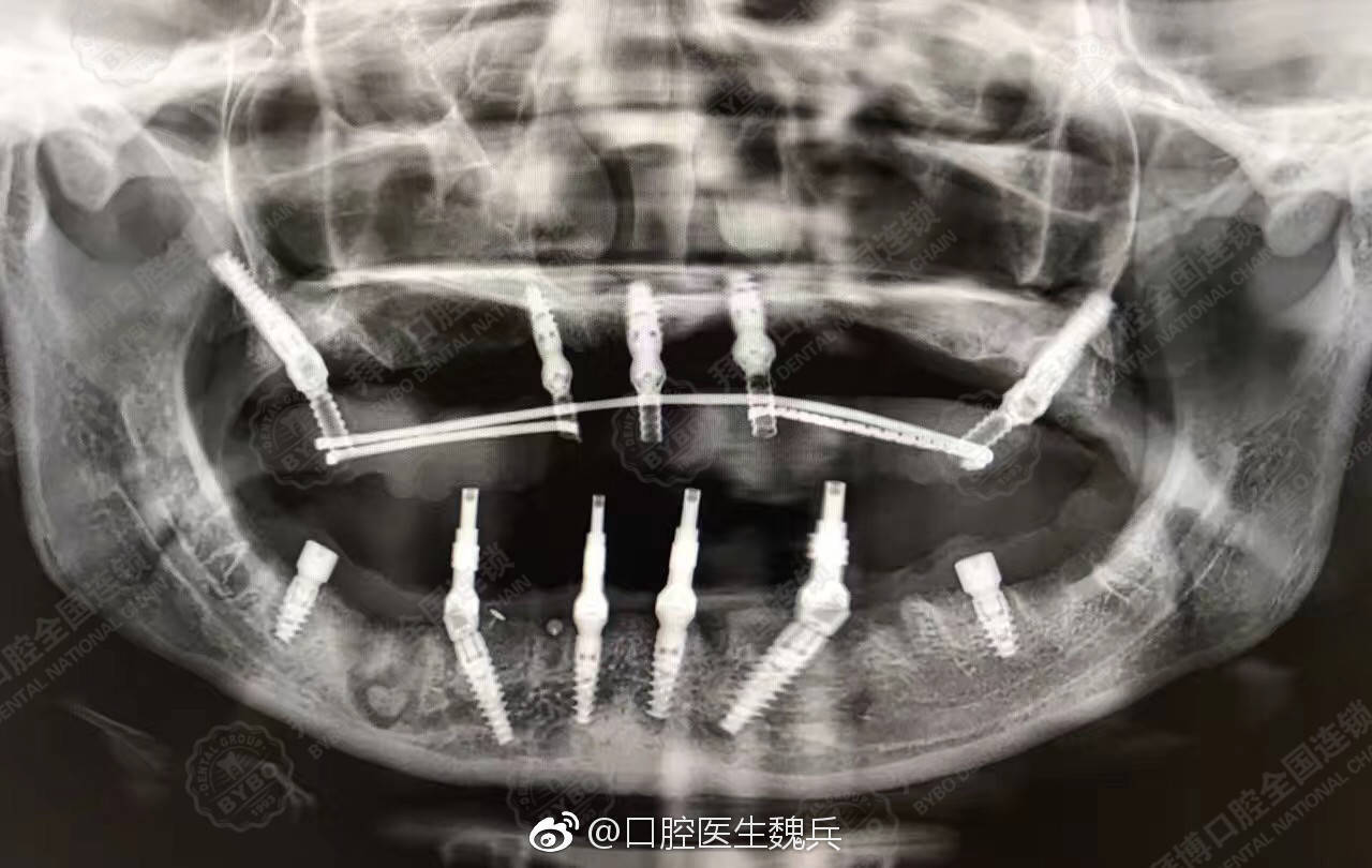 30歲的她牙齒都掉光了為什麼