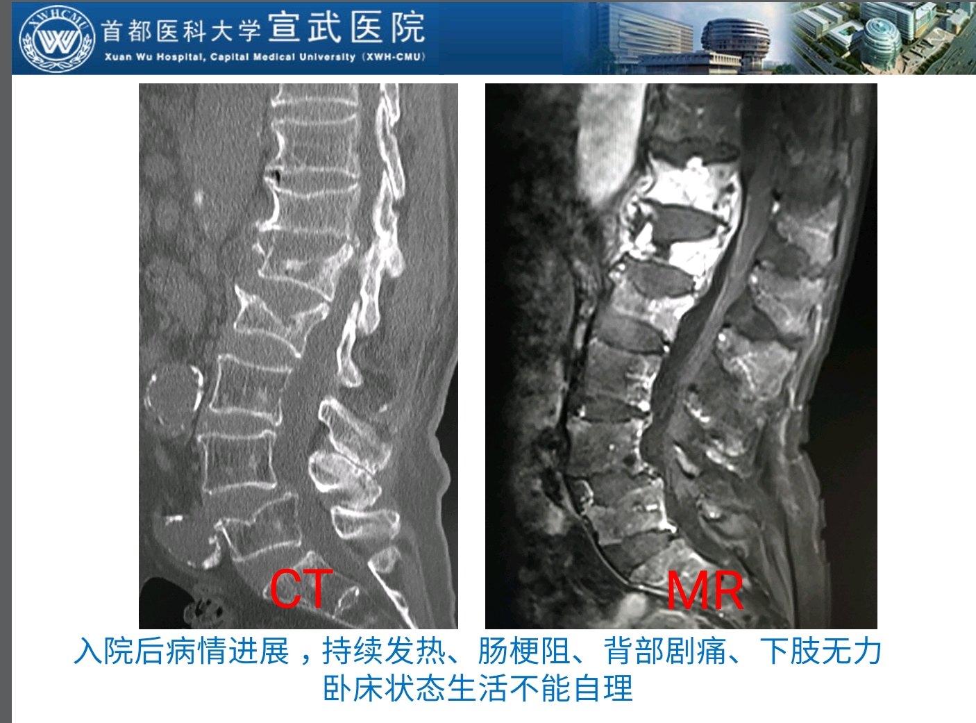 脊柱结核感染病例分享