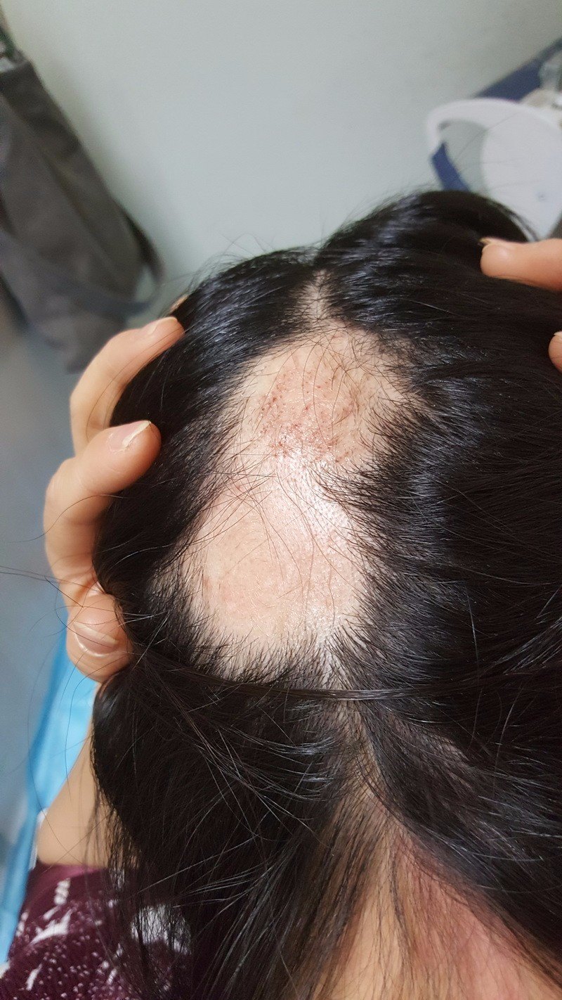 斑秃——火针治疗2个月后效果反馈,有图有真相 