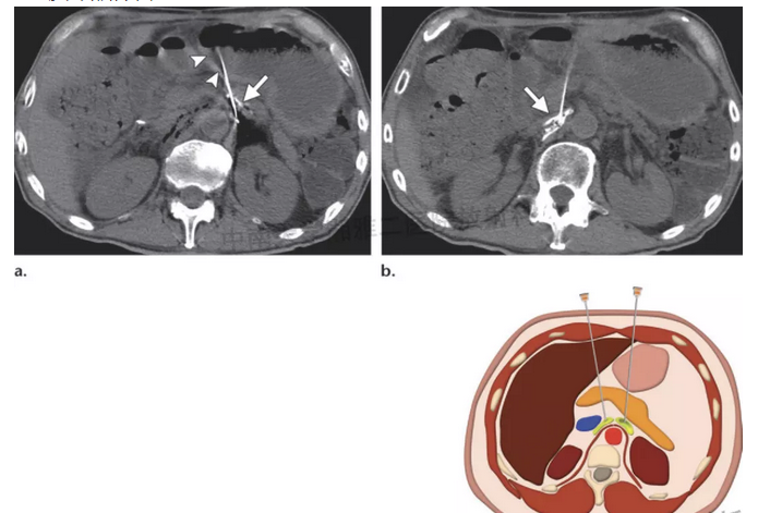 腹腔神经节(丛)消融术(celiac plexus neurolysis cpn)腹腔神经节(丛)