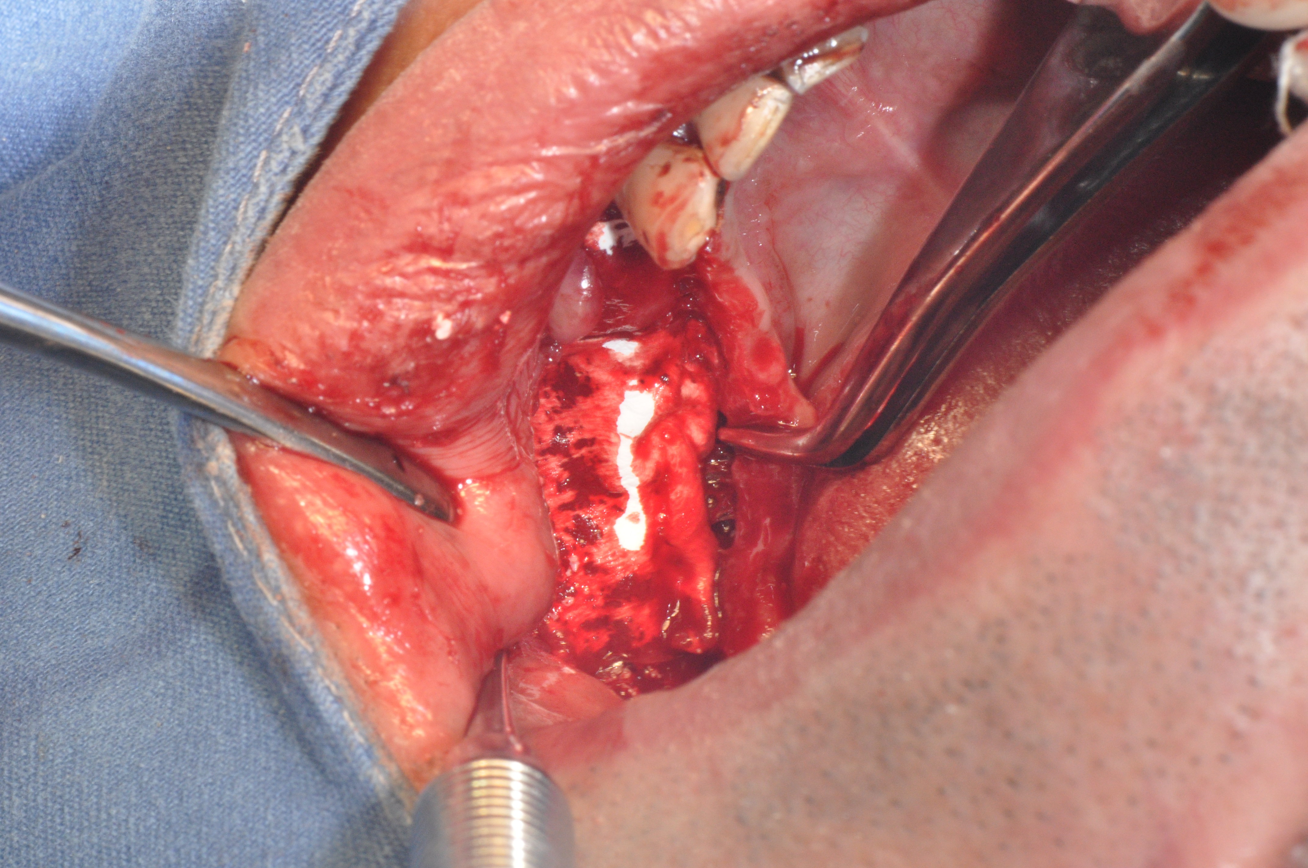 骨引导再生术 - 好大夫在线