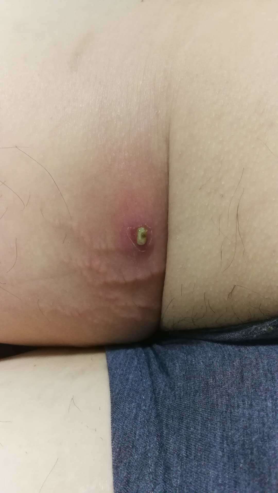 皮脂腺囊肿 粉瘤 需要手术吗 好大夫在线