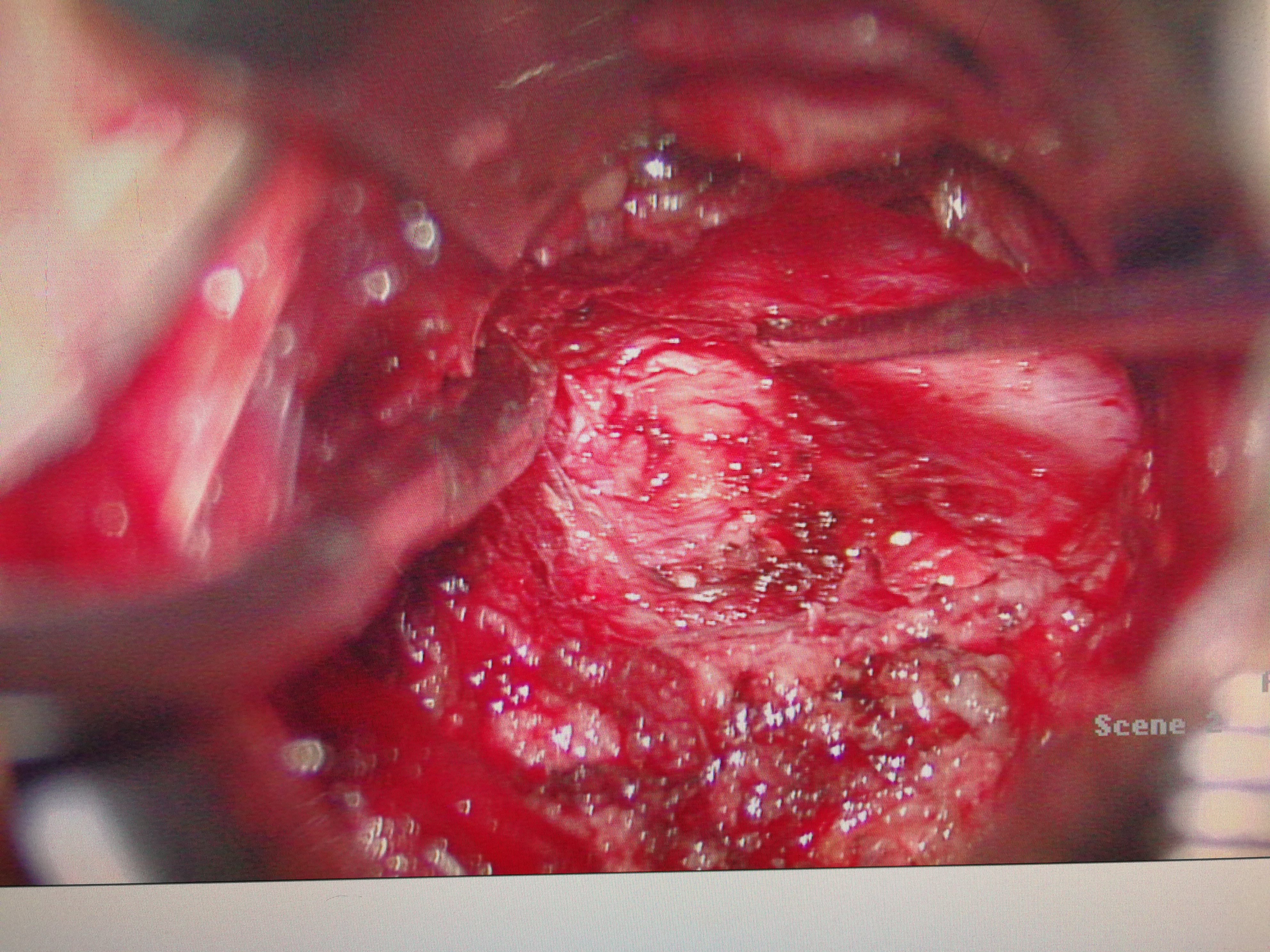 通道显微微创手术治疗腰椎间盘突出症