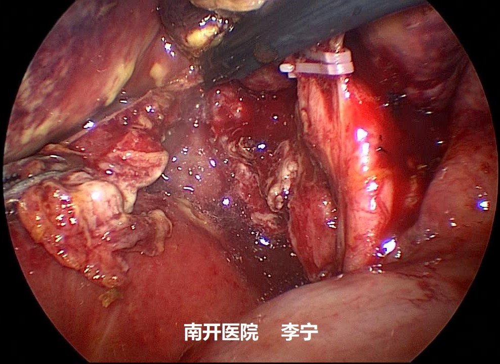 劉榮芝-34切除膽囊三角後壁壞死組織2-水印.jpg