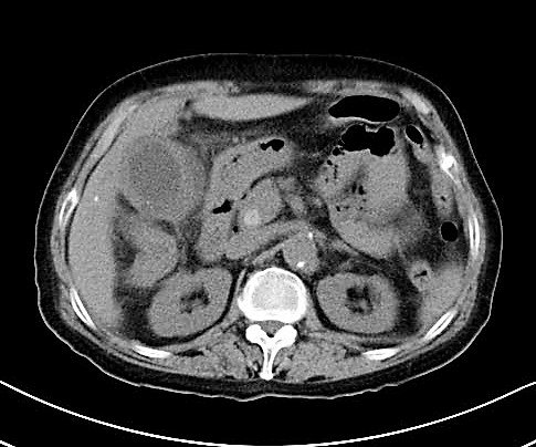 胆管结石CT图片