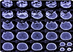 病例:手术治愈左侧桥小脑角表皮样囊肿致三叉