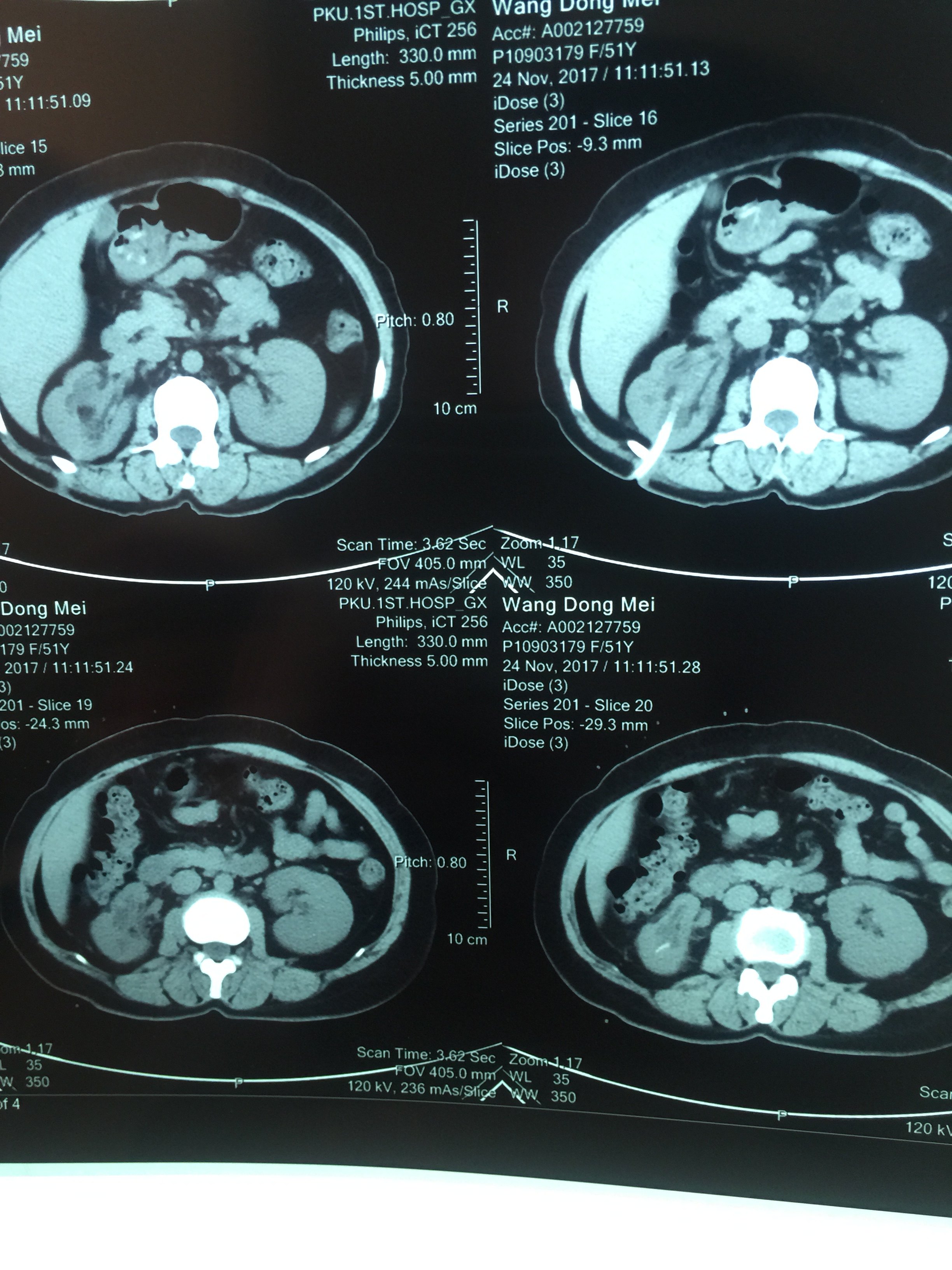输尿管损伤术式之1开放膀胱输尿管成
