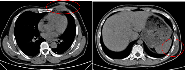 还可查找肺内及胸膜是否存在结核病,胸壁肿块相邻肋骨是否有破坏