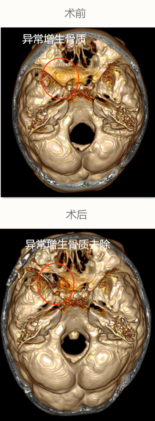 蝶骨骨纤维异常增殖症图片