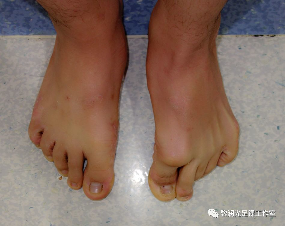 中风引起的脚部畸形如何治疗?