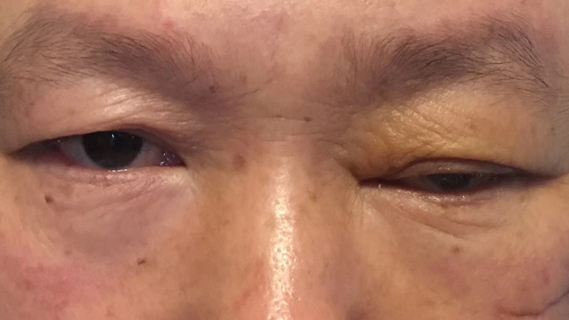 左动眼神经麻痹视神经损伤微创内镜术后改善 - 好大夫在线