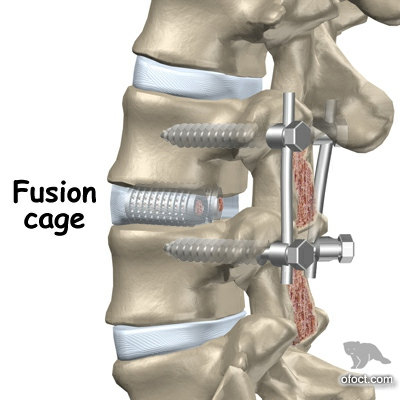 腰椎植骨融合内固定术图片